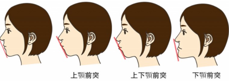 想要短鼻矫正，怎么做？详细过程了解！
